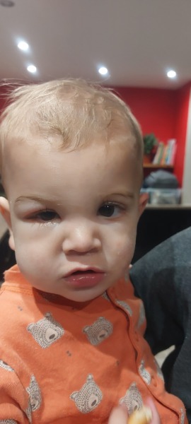 Swollen eye / face - conjunctivitis?