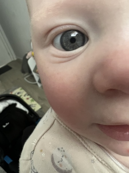 Lines/folds under baby's eye? Picture attached