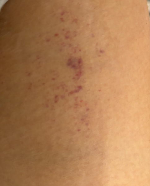 Should I be worried about this rash?!