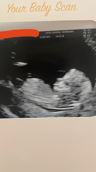 Show me your 12 week scan and tell me what you're had in the end!