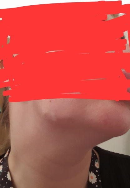 Jawline filler, are obvious lumps normal at first?