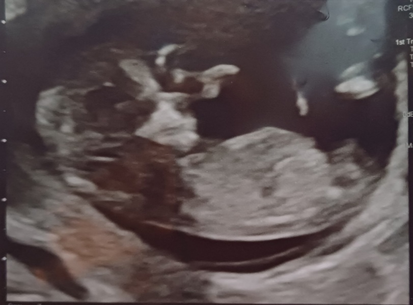 Baby gender
