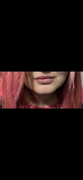 Can you tell I’ve had lip filler?