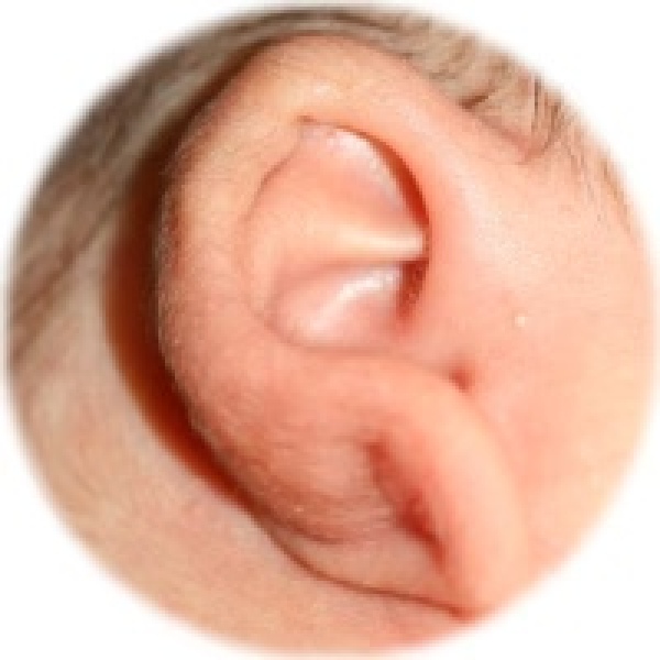 Badly folded baby ears—what to do?