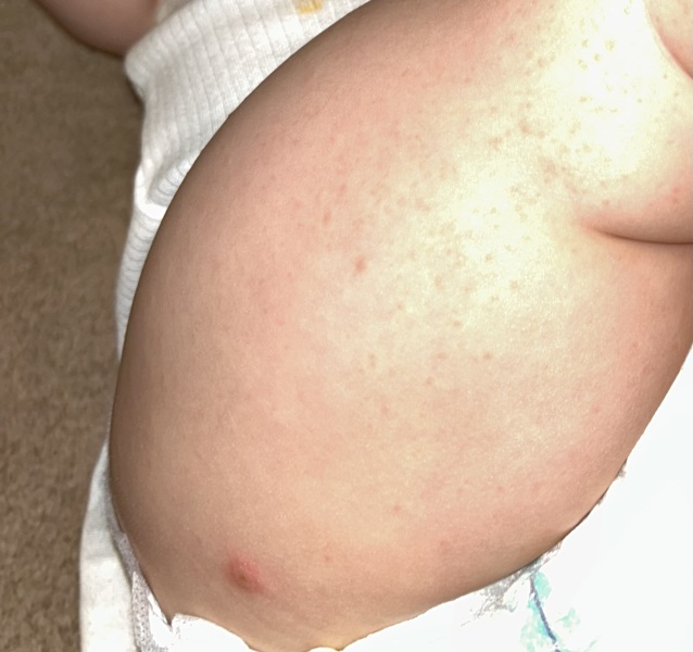 Chickenpox or HFM