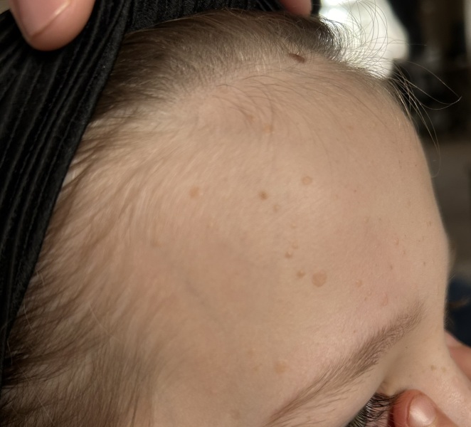 Skin tags on face?