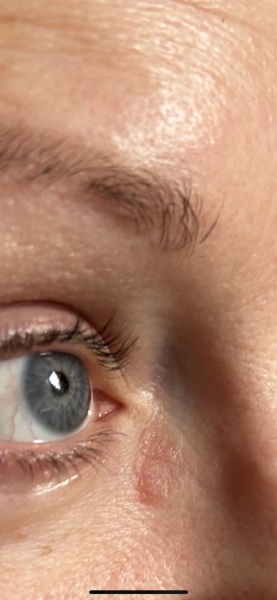 Scaly patch on face?