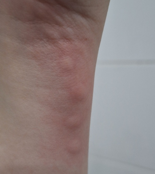 Is this a bite?