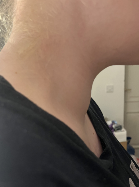 Swollen/lump in middle of neck