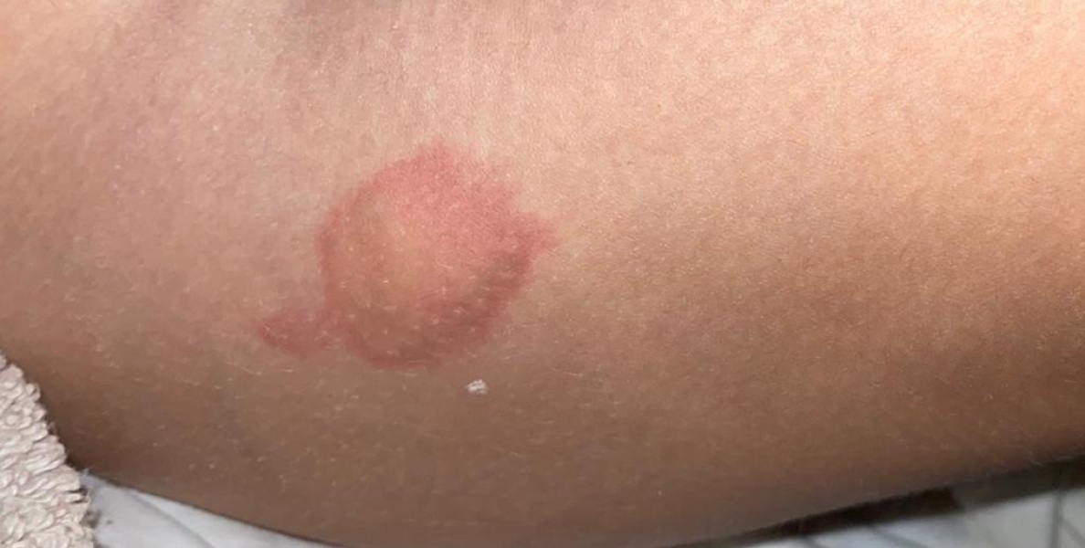 Burns advice
