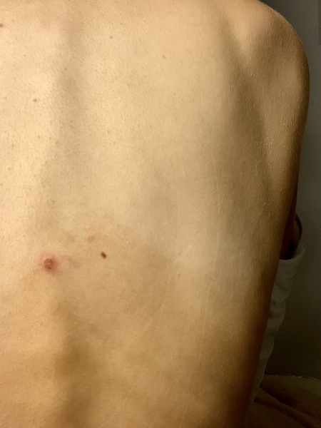 Skin lesion on back? Looks dodgy to me?