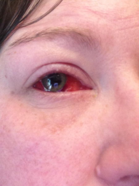Branch Retinal Vein Occlusion