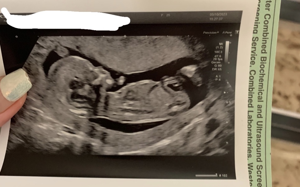 Nub theory, please? Second baby!