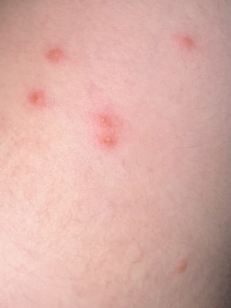 Chicken pox or bed bugs