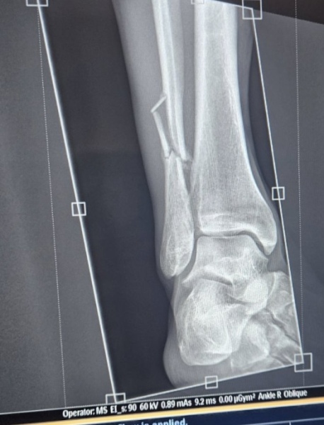 Anyone know how to read an X-ray? Pic included.