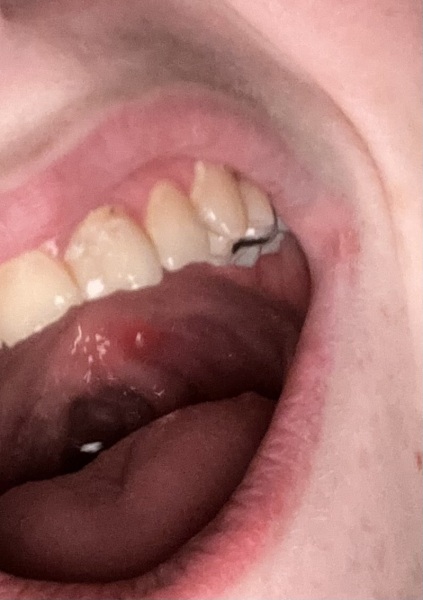 What is this at the back of my throat? Ulcer?
