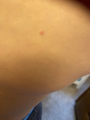 Chicken pox or bed bugs