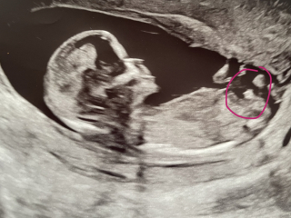Different baby in each scan?!
