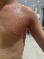Child irritated skin