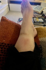 Shin injury