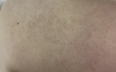 Spots or bumps on chest and arms