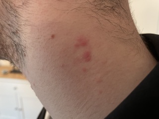 Sudden rash on neck
