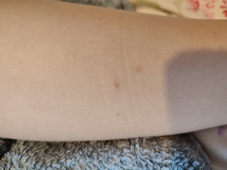 Spots on 5 year olds leg