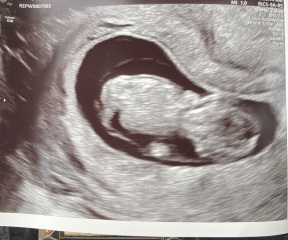Is my placenta on left or right side?
