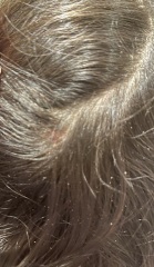 please advise is this dandruff , pic included