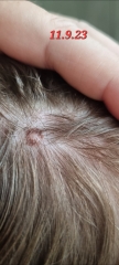 Worried about mole on daughters scalp