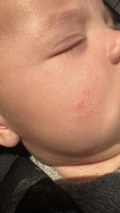 Baby eczema or something else??