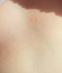 Chickenpox?