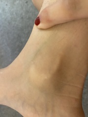 Is this normal? Veins