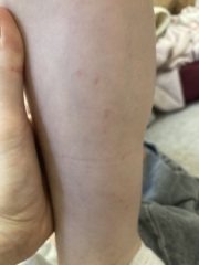 Does this look like bed bug bites?