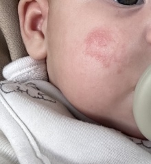 Baby eczema or something else??