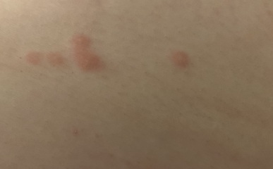 Are these bed bug bites ?