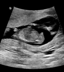 13 week ultrasound - gender guesses