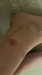 What's bitten me ??