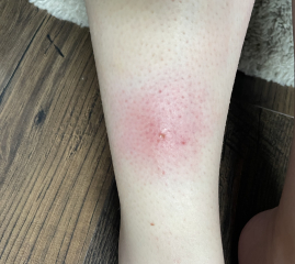 Cellulitis?
