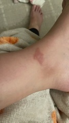 What's bitten me ??