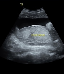 28 week scan ? Gender on show