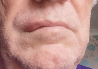 Allergic reaction to lucozade sport?