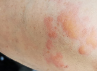 Allergic reaction to lucozade sport?