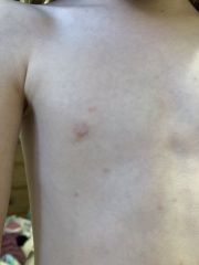 Does this look like bed bug bites?