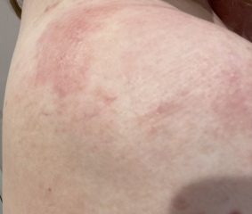 ‘Covid’ rash post vaccines (pics)