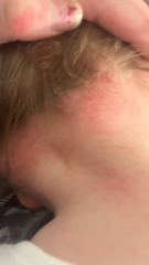 Baby rash & reaction to hydrocortisone