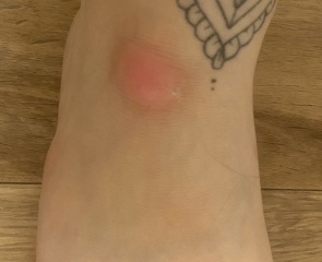 Soft lump on ankle