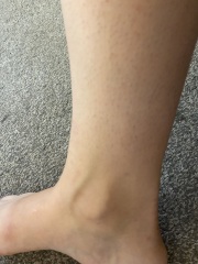 Is this normal? Veins