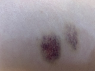 Unexplained bruising