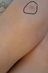 Bruises from nursery